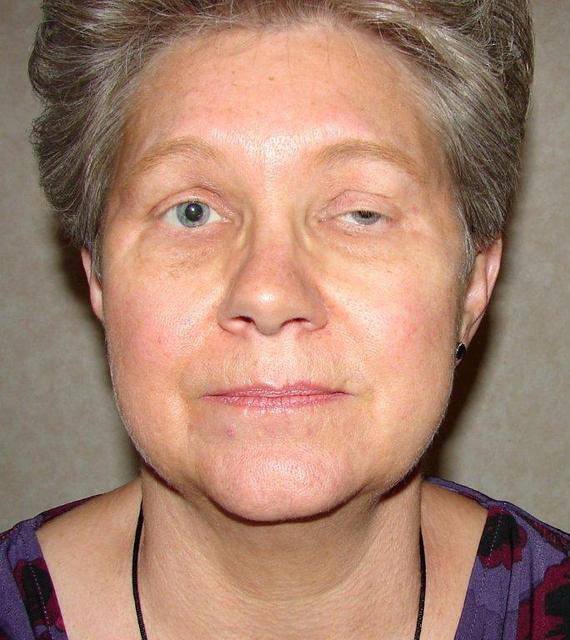 Shirley's Ptosis