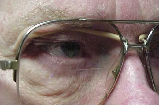 Ptosis Crutches