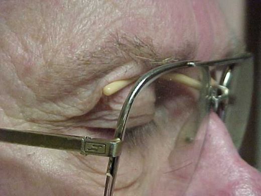 Ptosis Crutches