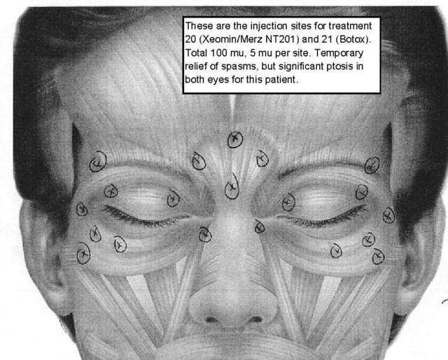Injection sites used including eyelids 
