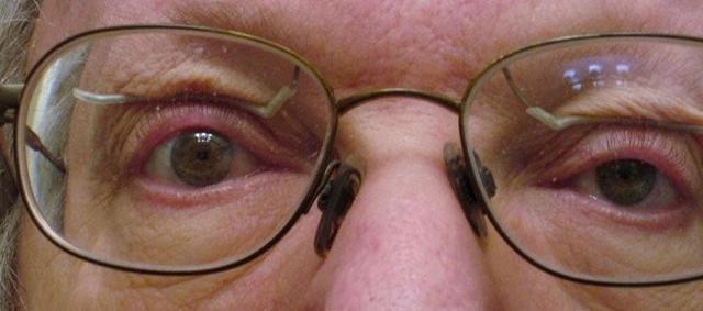 Peter's Ptosis Crutches