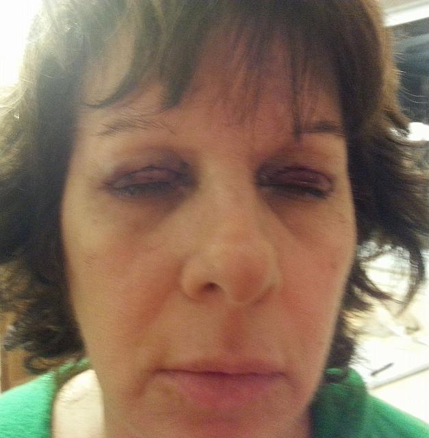 Ptosis Repair