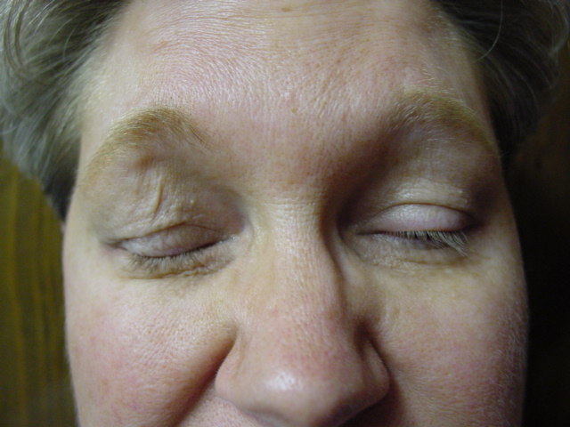 Shirley Barr Pre-operative