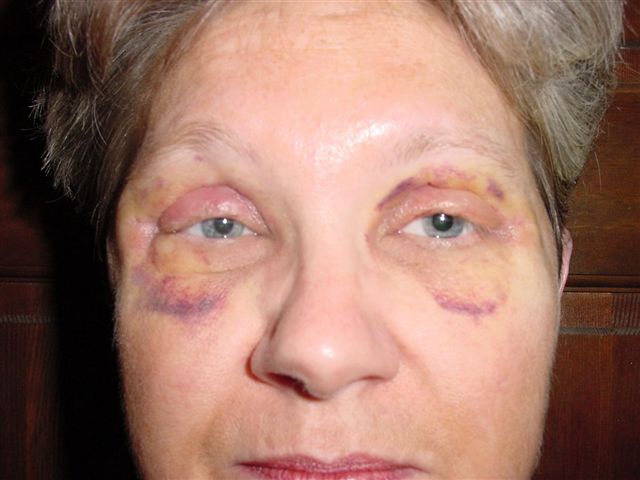 12 Days Post-op Close-up