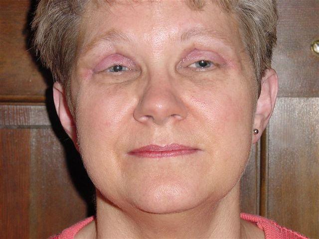 32 Days After Surgery
