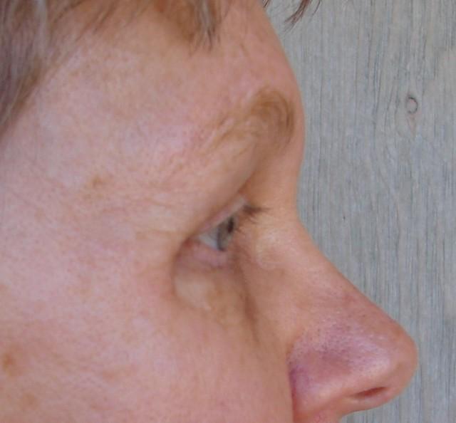 7 Years After Surgery