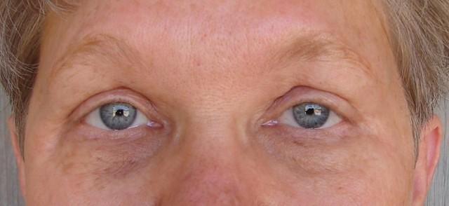 7 Years After Surgery