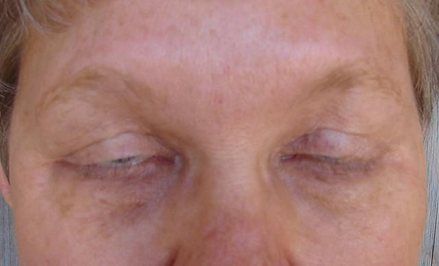 7 Years After Surgery