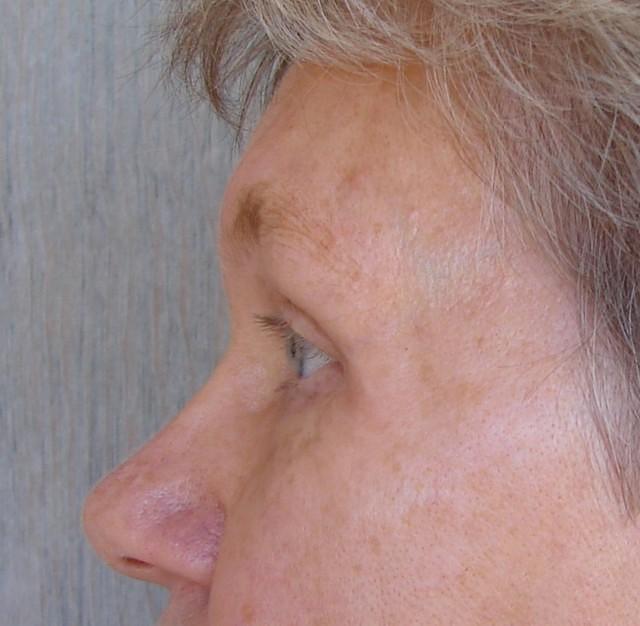 7 Years After Surgery