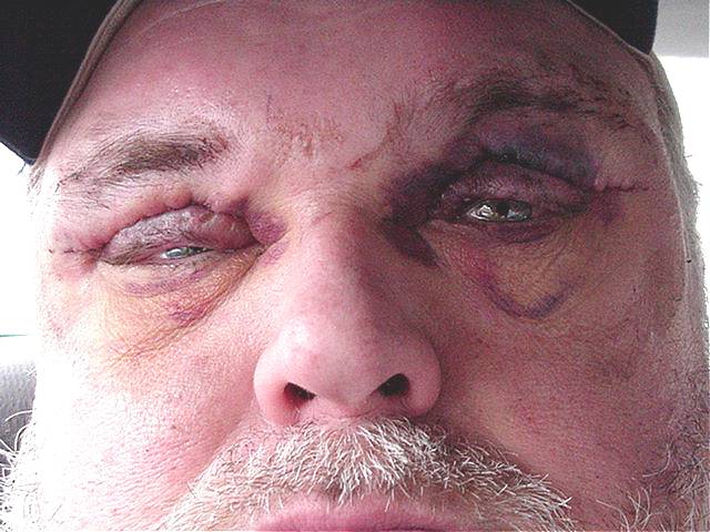 Steve Stephens 3 Days After Surgery
