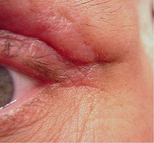 Left Eye 5 Weeks After Surgery