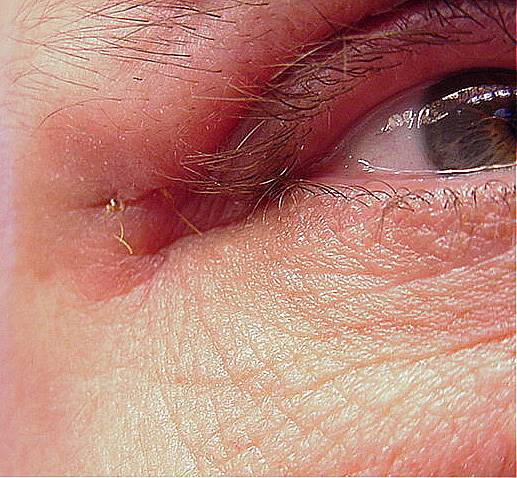 Right Eye 5 Weeks After Surgery