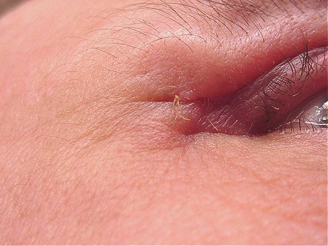 Close up Right Eye 5 Weeks Post-op
