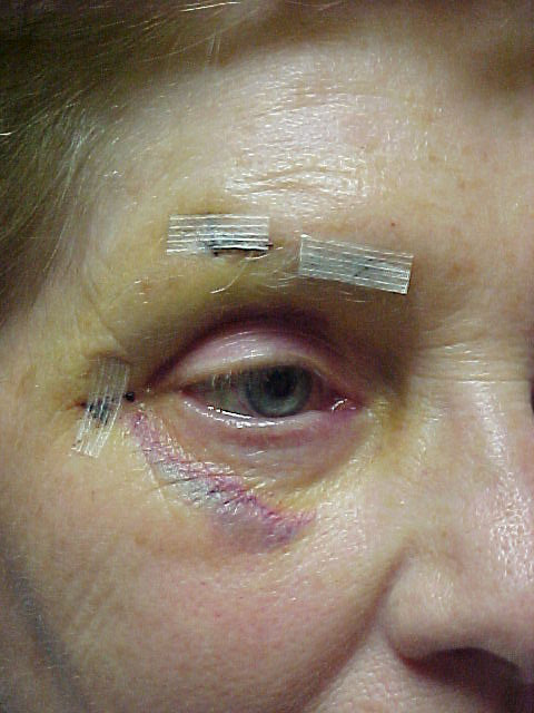 Right Eye