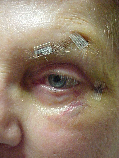 Left Eye