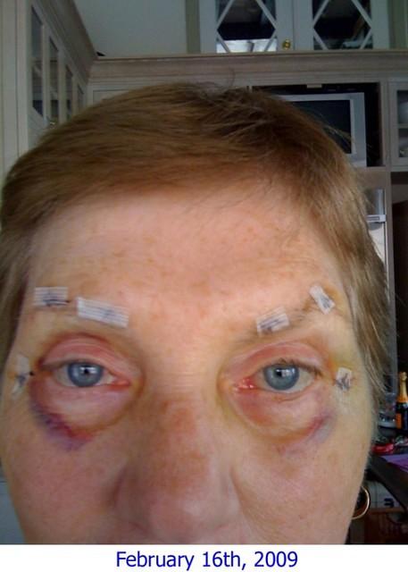 3 Days After Surgery