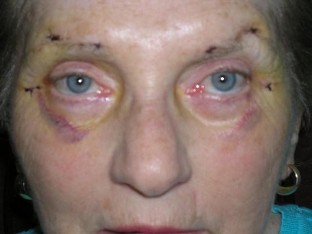 11 Days After Surgery