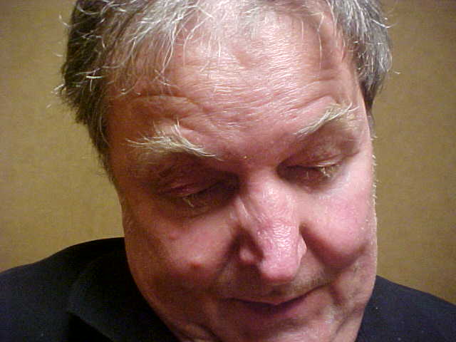 Before Surgery