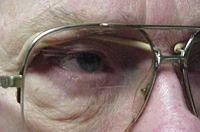 Ptosis Crutches