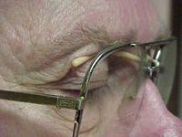 Ptosis Crutches