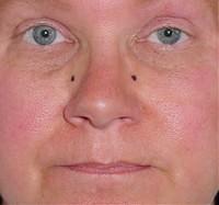 Injection Site for "bunny nose"