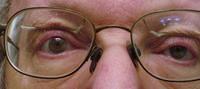 Peter's Ptosis Crutches