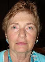 Surgery: Pre-op and Post-op Photos