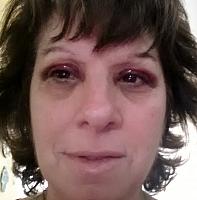 Iris Naroden Ptosis Repair