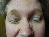 Shirley Barr Pre-operative