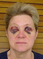 Shirley Barr 3rd Day Post-op