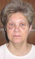Shirley Barr 12 Days After Surgery