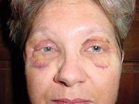 12 Days Post-op Close-up