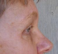7 Years After Surgery