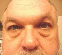 Steve Stephens-Myectomy