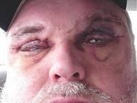 Steve Stephens 3 Days After Surgery