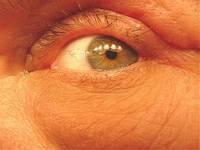 Left Eye 5 Weeks Post-op