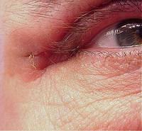 Right Eye 5 Weeks After Surgery