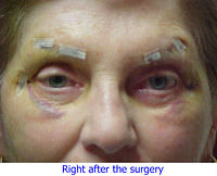 Right After the Surgery