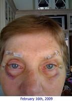 3 Days After Surgery