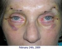 11 Days Post Op