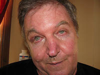 Gary Krahn- Limited Myectomy