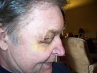 Gary Krahn Post-op 